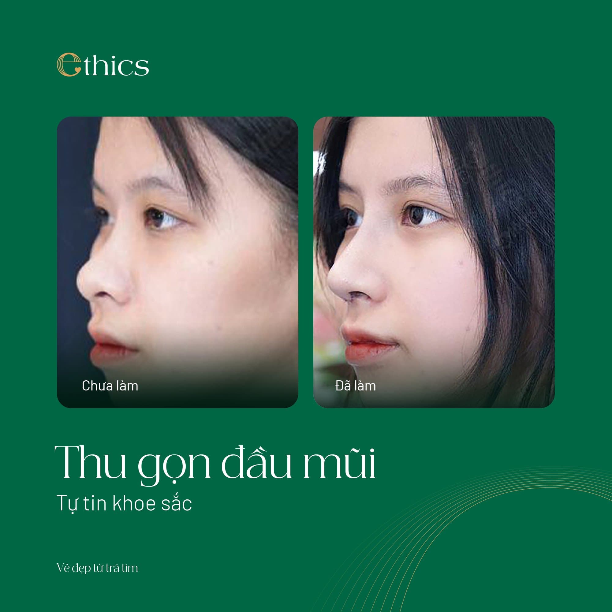 Rhinoplastie