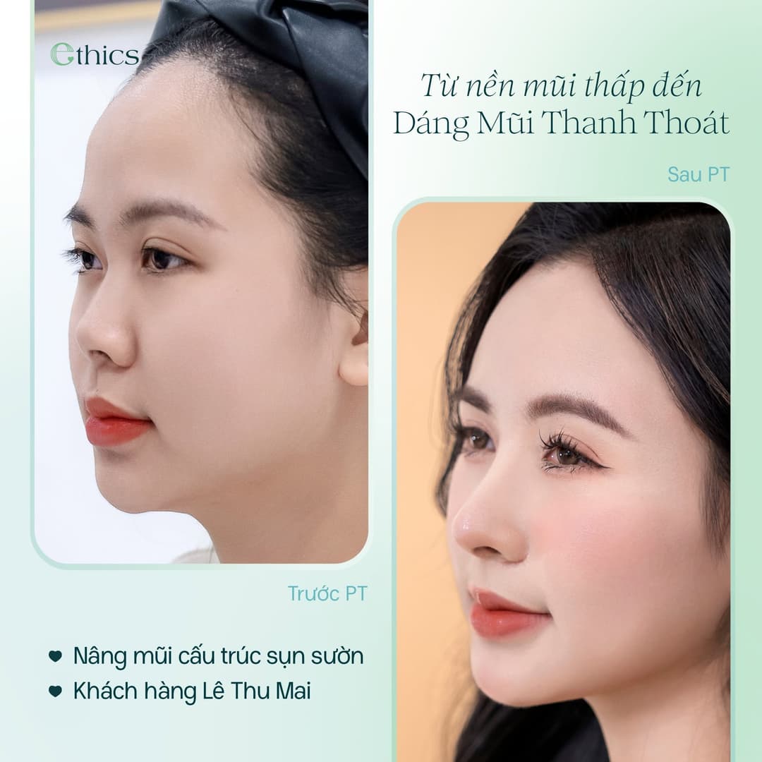 Photo du cas de rhinoplastie structurale au cartilage costal de Lê Thu Mai publiée par Ethics le 20/09/2026