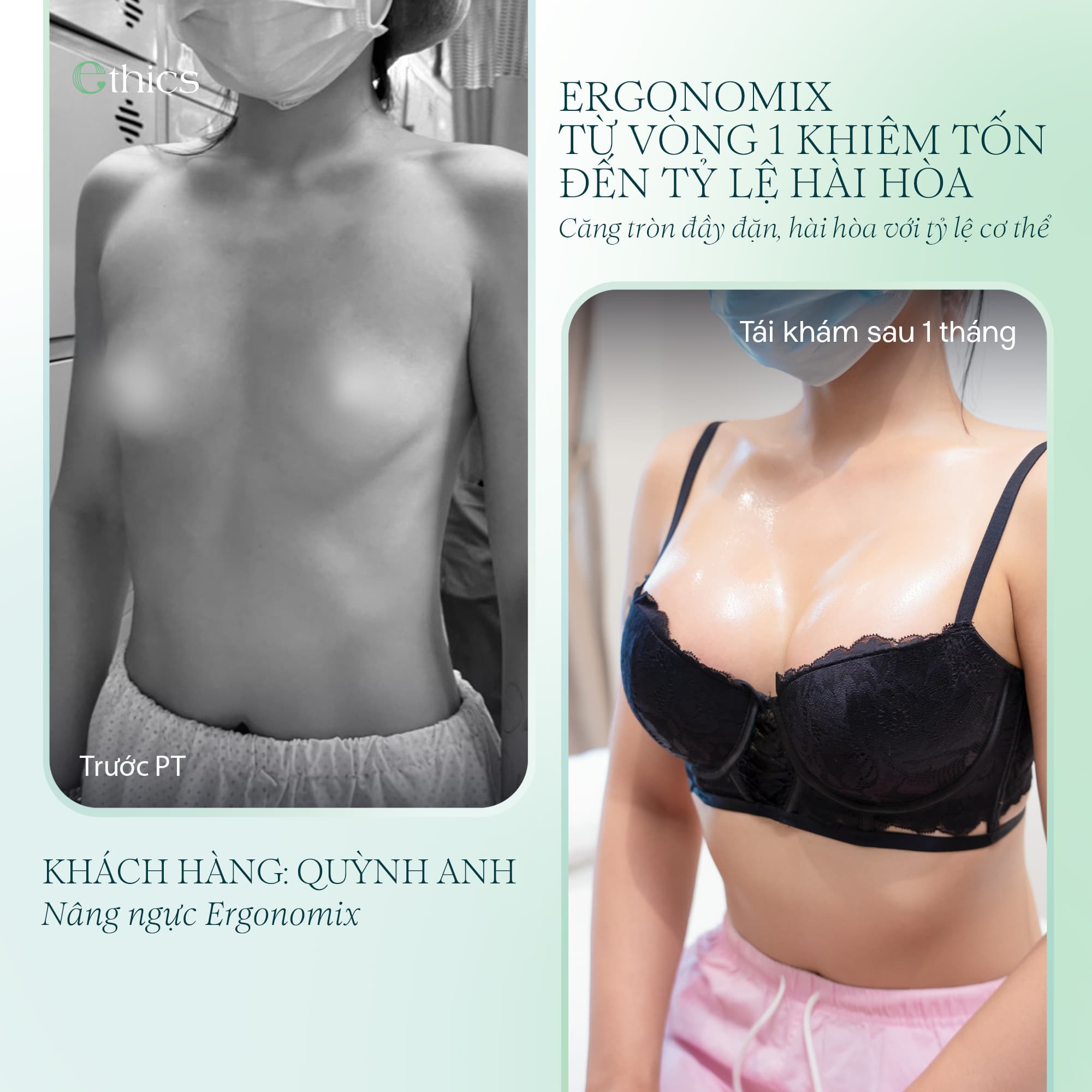 Augmentation mammaire