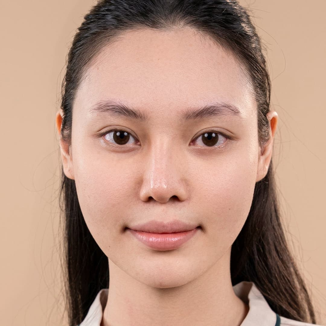Patiente Lưu Phương Anh - Avant l'intervention de rhinoplastie One fit