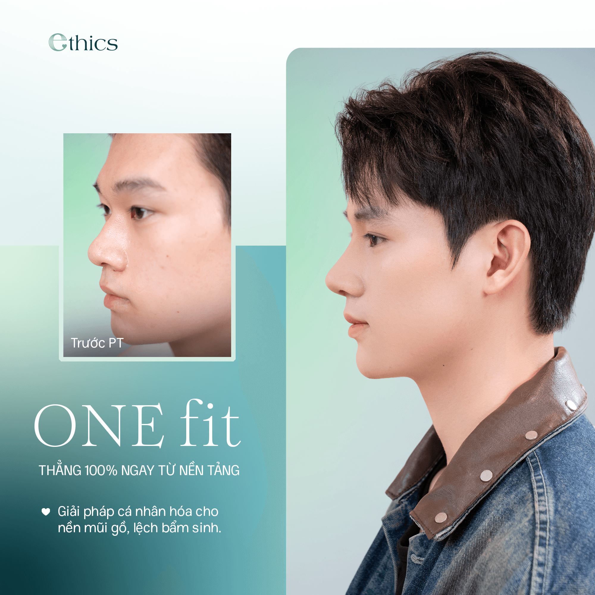 Rhinoplastie OneFit