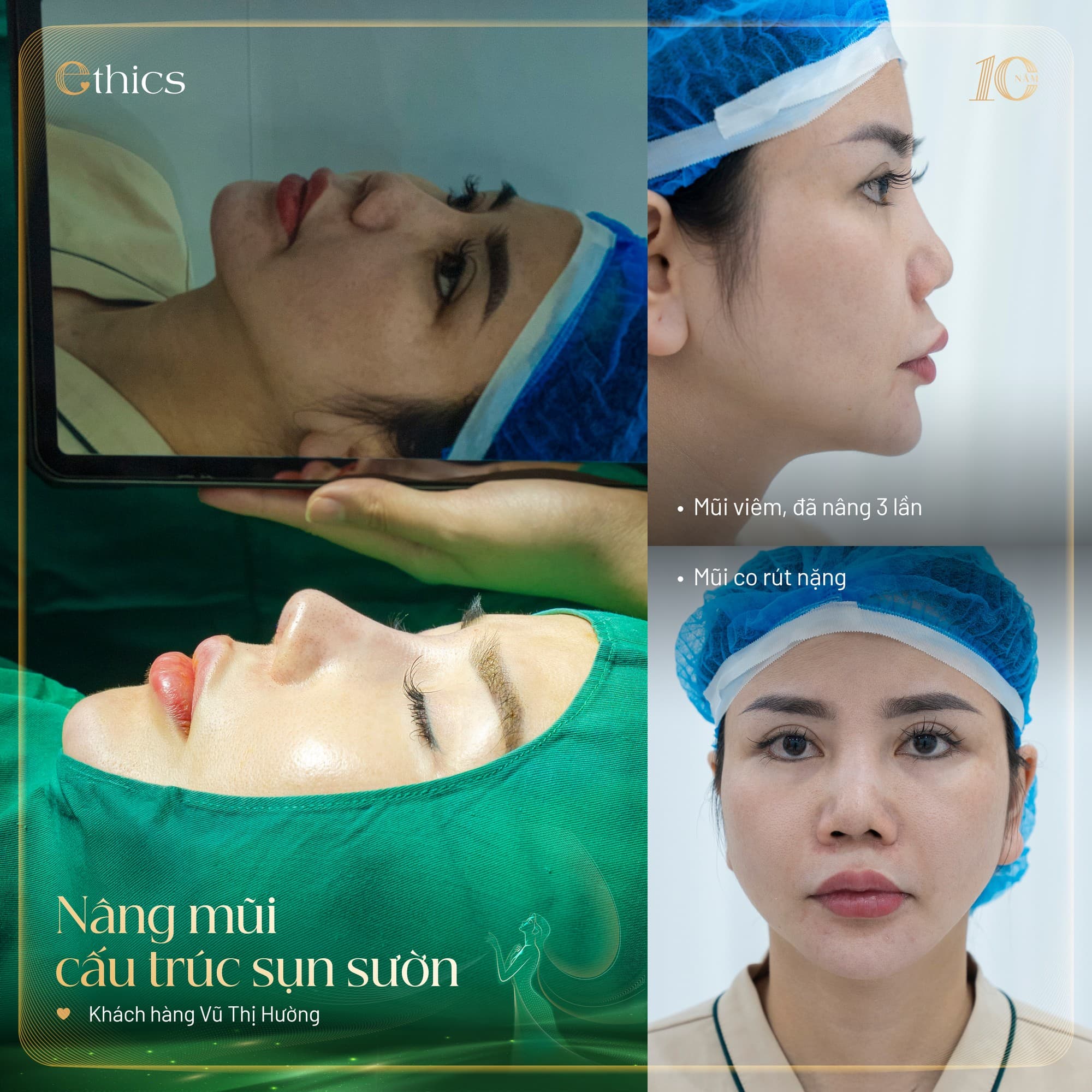 Greffe de cartilage