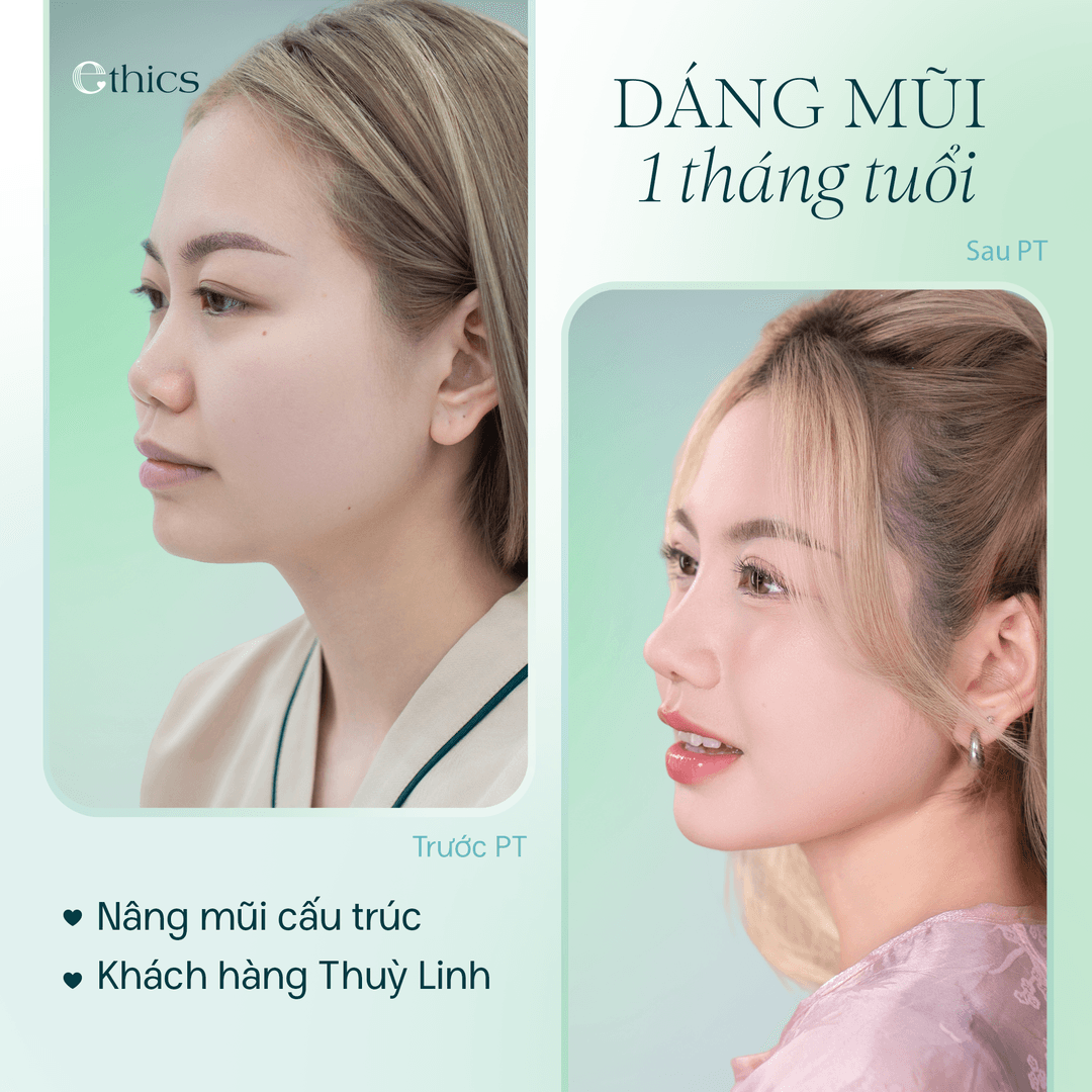 Comparaison avant et après une rhinoplastie structurelle du patient