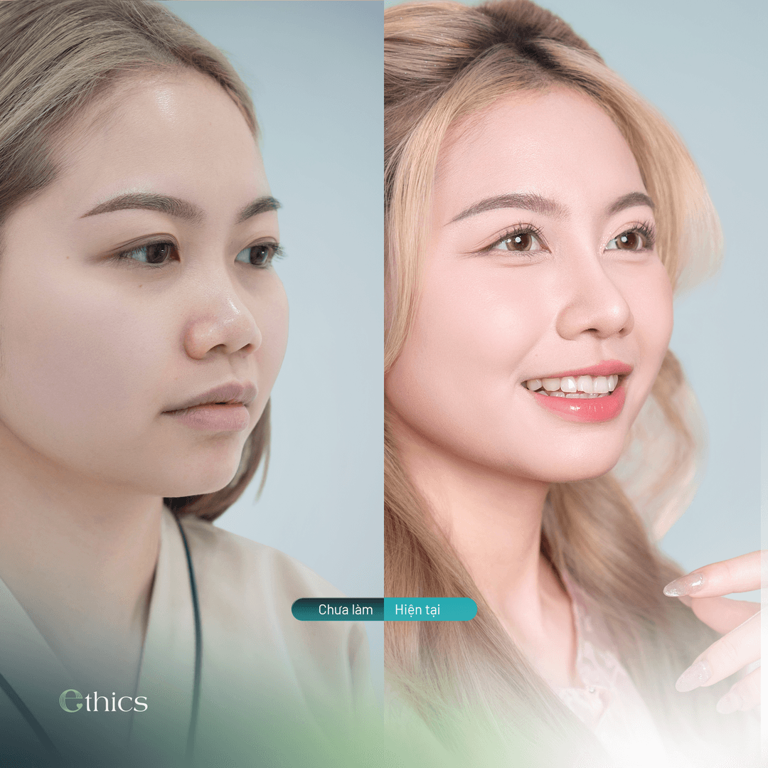 Comparaison des photos avant et après la rhinoplastie d'une patiente