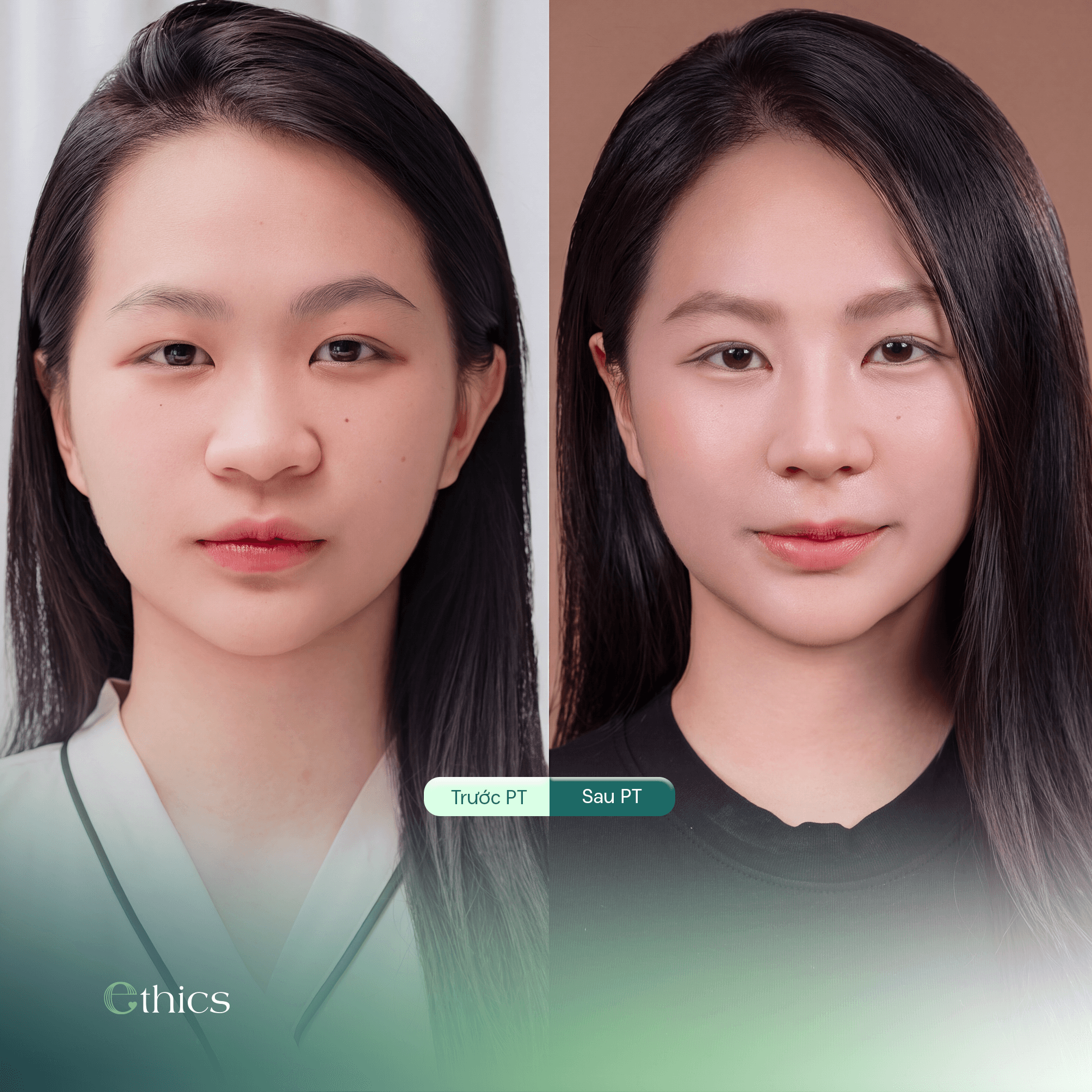 Comment bien prendre soin de la zone de prélèvement du cartilage costal après une rhinoplastie ?