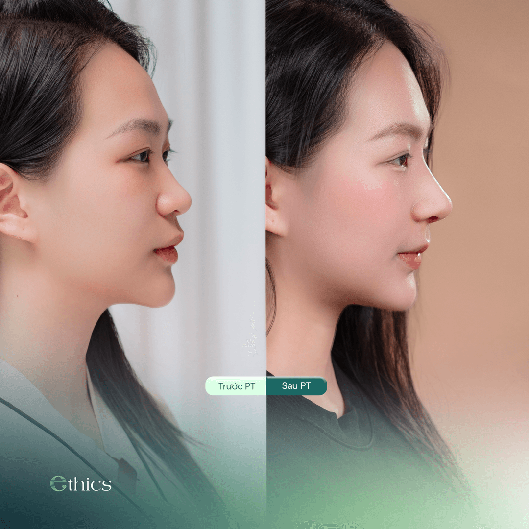 Photo de profil comparant le nez avant et après une rhinoplastie du patient