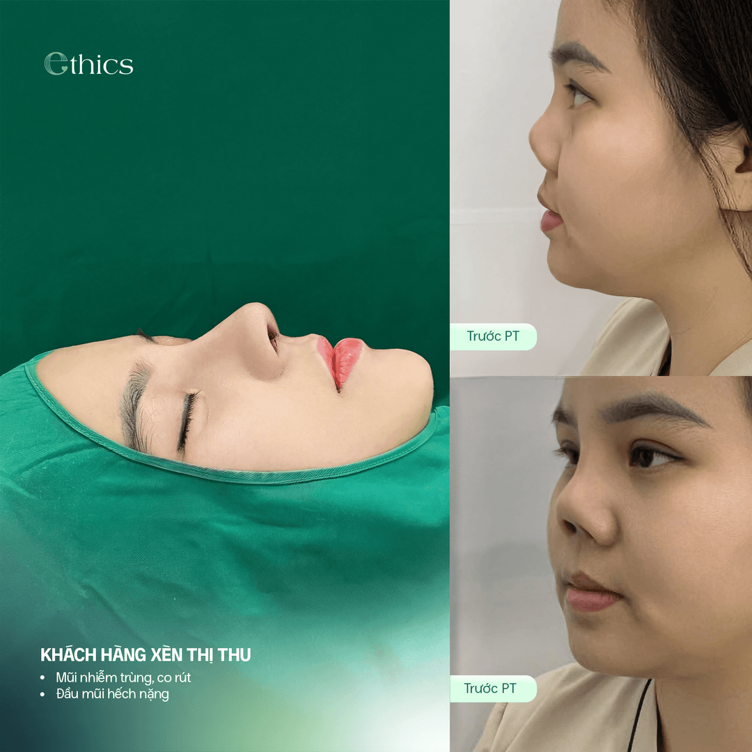 Photo comparant la structure du nez avant et après une rhinoplastie structurale