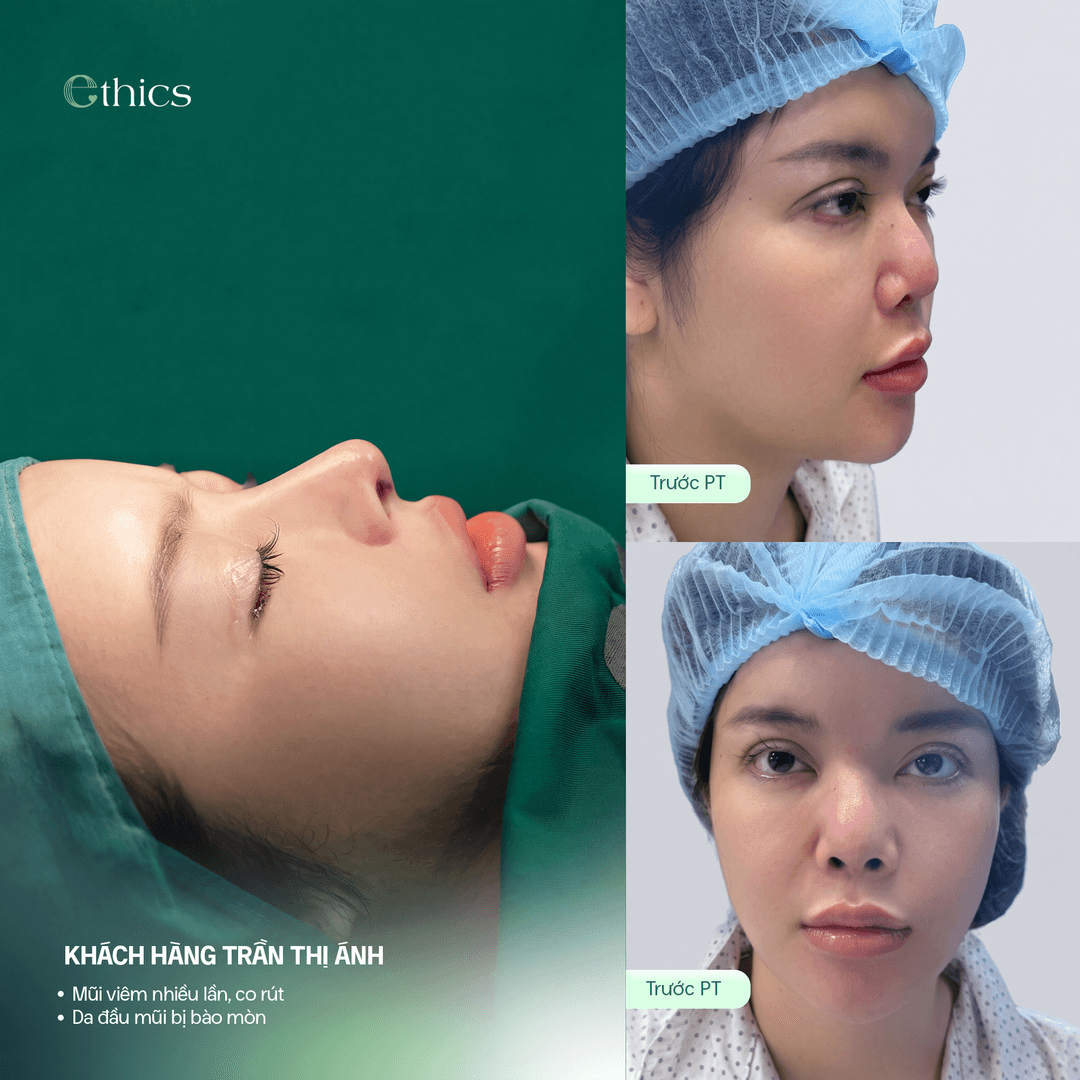 Photo d'une patiente avant une rhinoplastie structurale par cartilage costal
