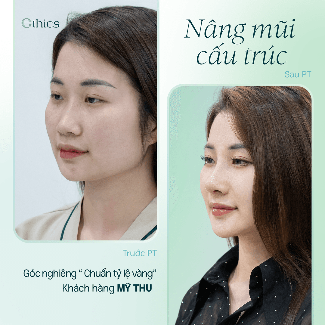 Rhinoplastie structurale - 10 jours pour un nouveau visage