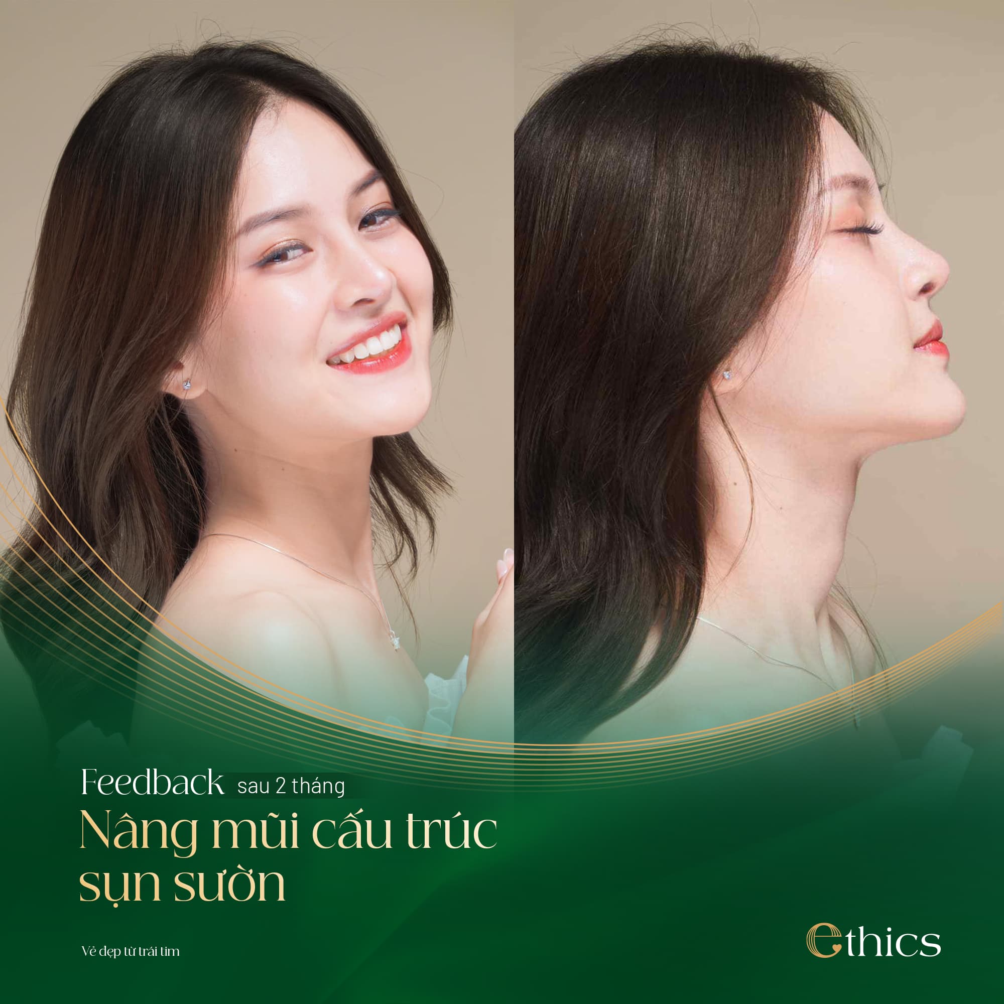 Rhinoplastie structurelle