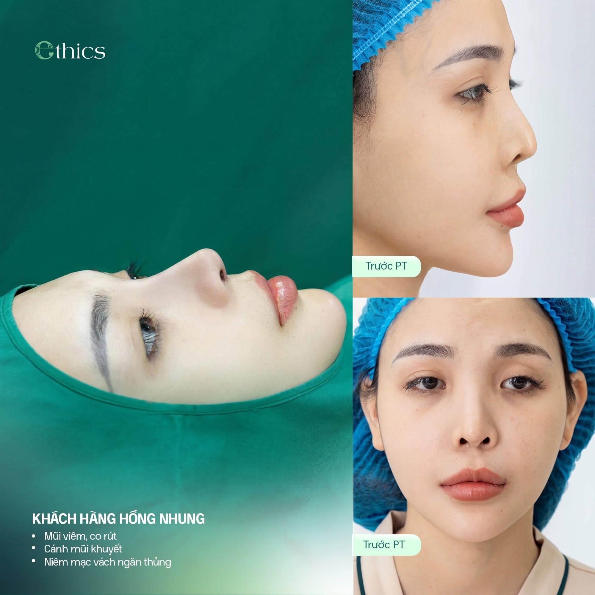 Pour une rhinoplastie, comment choisir entre cartilage costal et cartilage septal ?