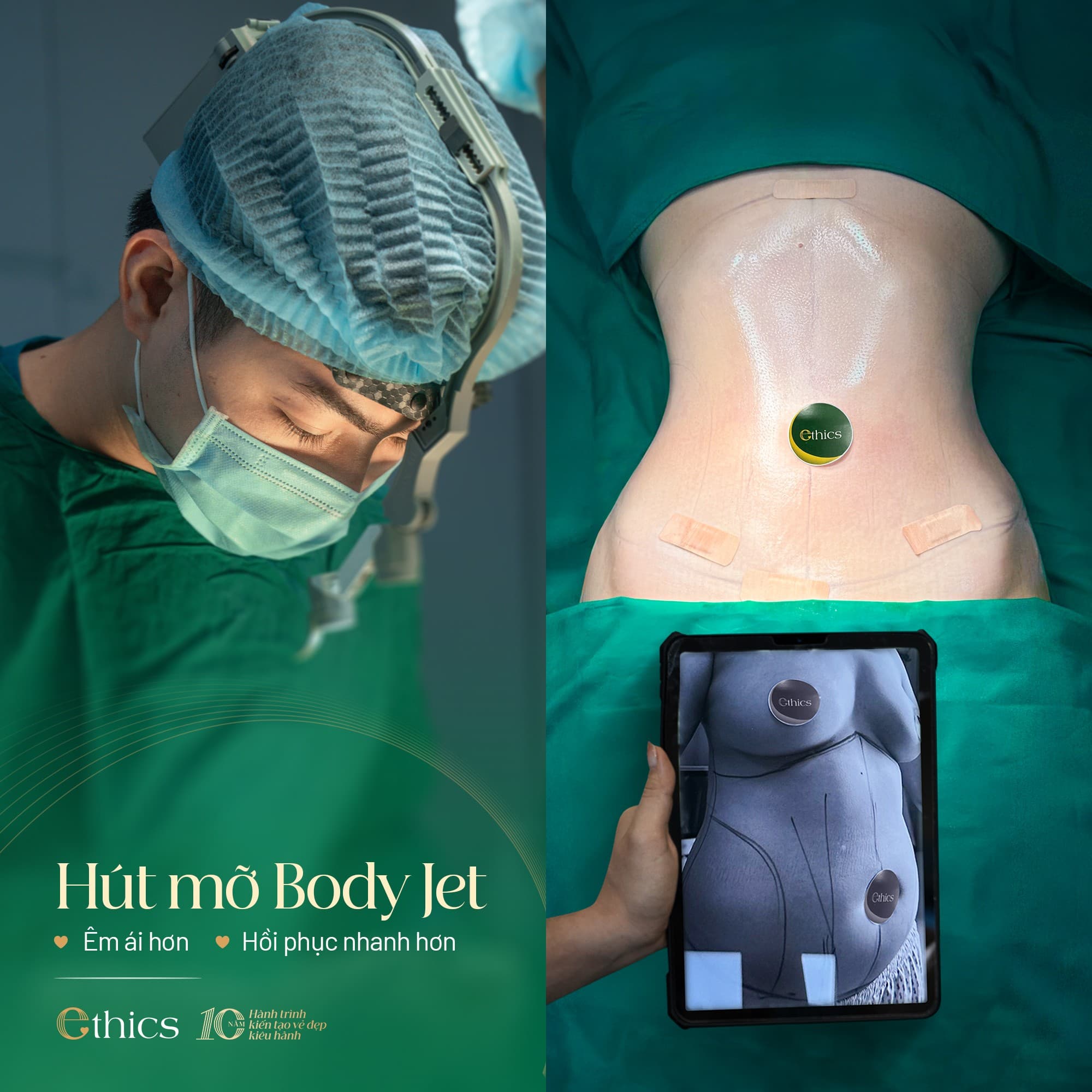 Liposuccion Body Jet