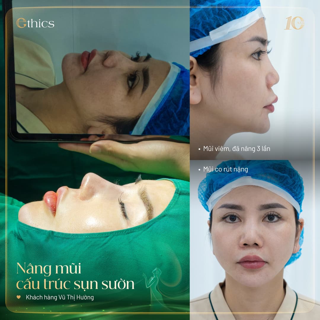 Greffe de cartilage autologue pour la rhinoplastie Ethics