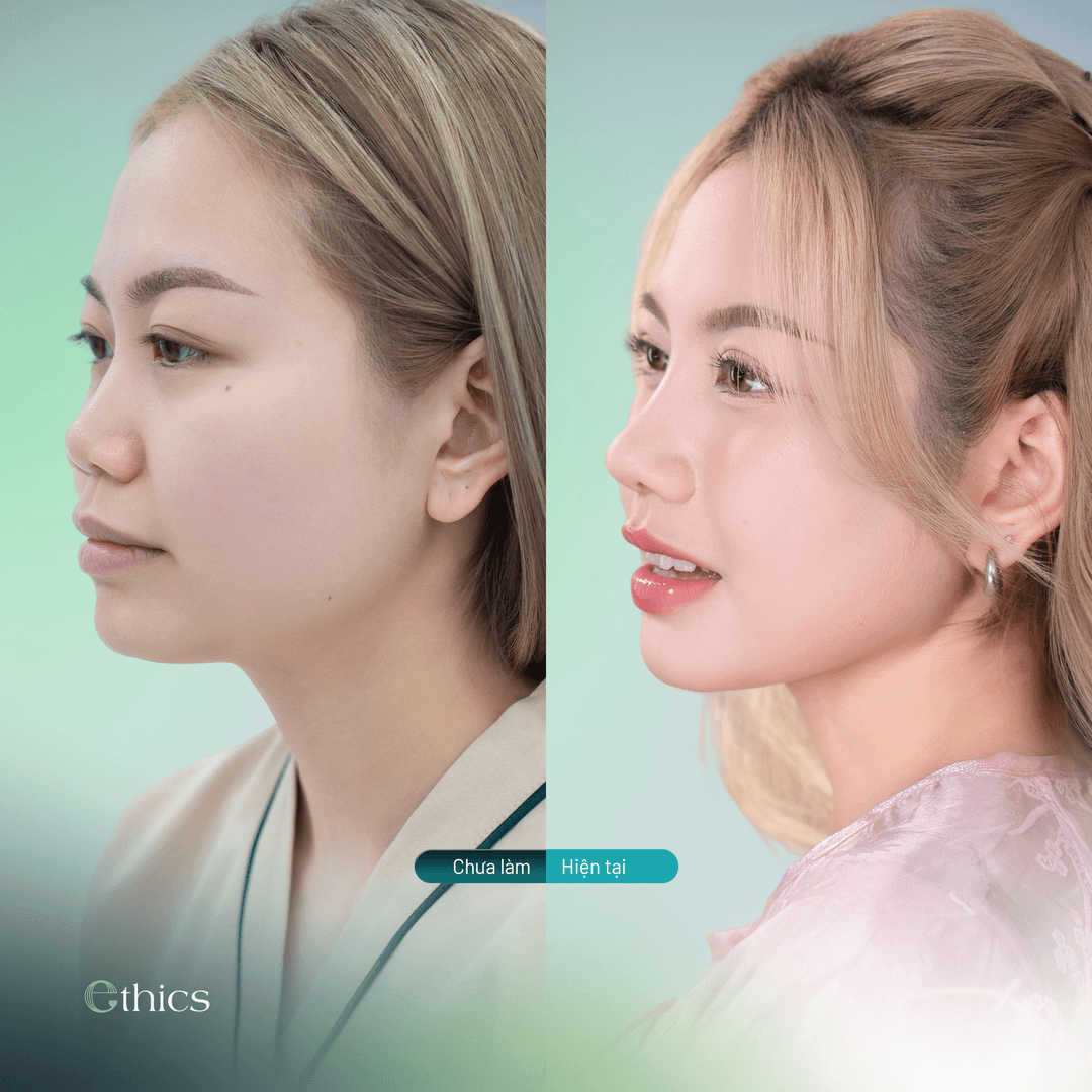 Photos comparatives avant et après une rhinoplastie chez une cliente